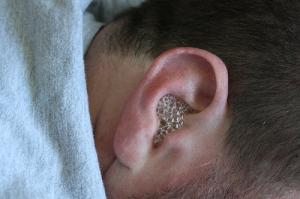 Name:  complications_of_ear_infection.jpg
Views: 14109
Size:  9.0 KB